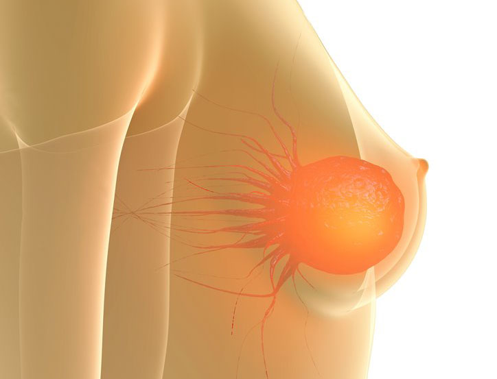 metastatic breast cancer treatments