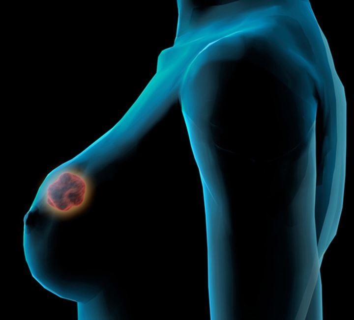 the types of breast cancer