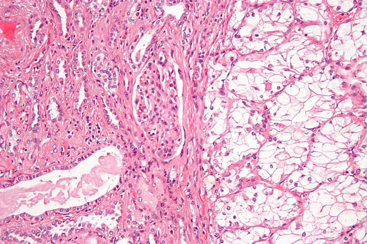 metastatic renal cell carcinoma treatment, renal cell carcinoma diagnosis, metastatic renal cell carcinoma, metastatic renal cell carcinoma treatments, What is Renal Cell Carcinoma Cancer?, metastatic renal carcinoma treatments, metastatic renal cell carcinoma diagnosis, renal cell carcinoma treatment, renal cell carcinoma, alternative kidney cancer treatment, advanced kidney cancer treatments, kidney cancer survival rates, treatment advanced kidney cancer, metastatic kidney cancer treatments, treatment for metastatic kidney cancer