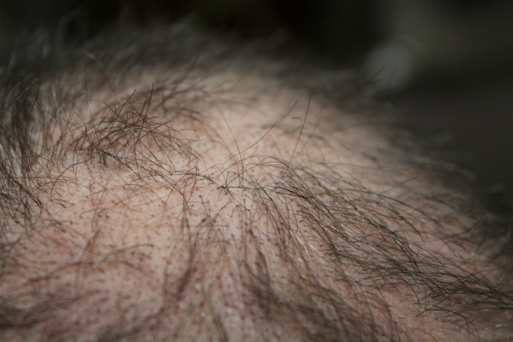 Get the Ultimate Hair Loss Treatment for Your Hair, hair loss, hair loss treatment