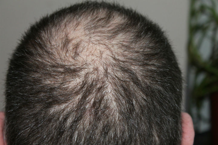 Get the Ultimate Hair Loss Treatment for Your Hair, hair loss