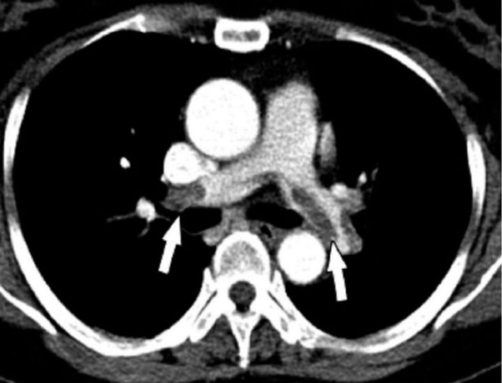 treatment pulmonary embolism, pulmonary embolism treatment, pulmonary embolism treatments, treatments for pulmonary embolism, treatment for pulmonary embolism, pulmonary embolism info