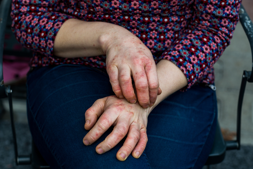 atopic dermatitis eczema treatments