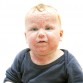 atopic dermatitis eczema