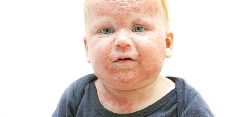 atopic dermatitis eczema