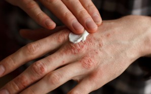 Emuaid Shingles Treatment
