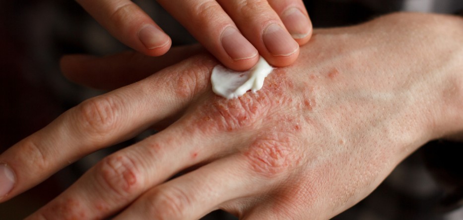 Emuaid Shingles Treatment