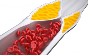 Cholesterol Medications Not Statins