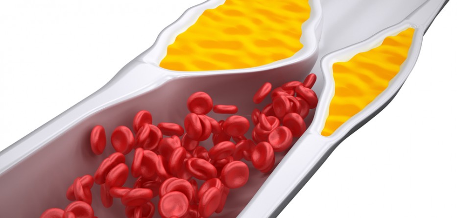 Cholesterol Medications Not Statins