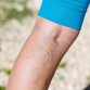 Varicose Eczema