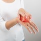 atopic dermatitis hand treatment