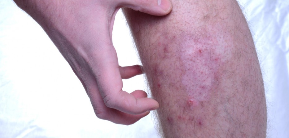 chronic atopic dermatitis treatment