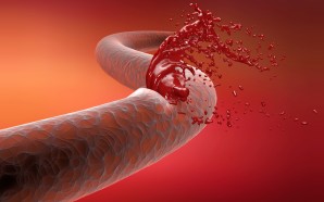 hemophilia a treatment