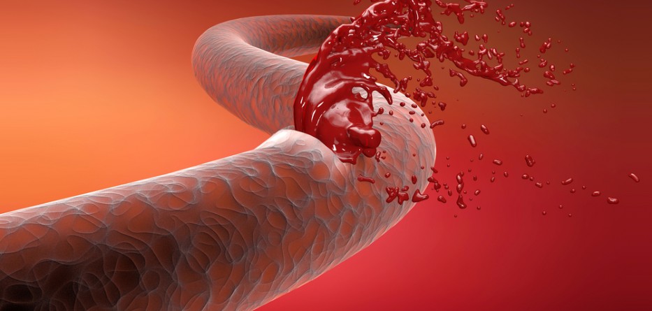 hemophilia a treatment