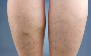 deep vein thrombosis medications