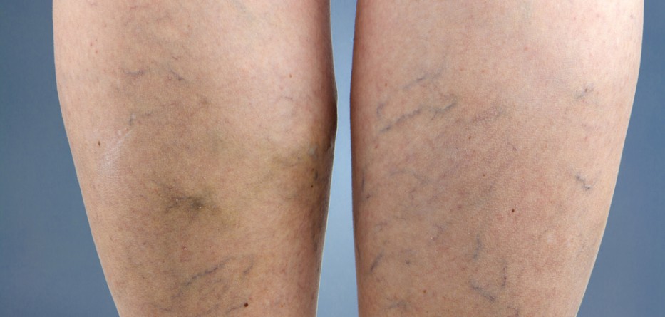 deep vein thrombosis medications