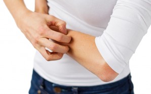 eczema atopic dermatitis