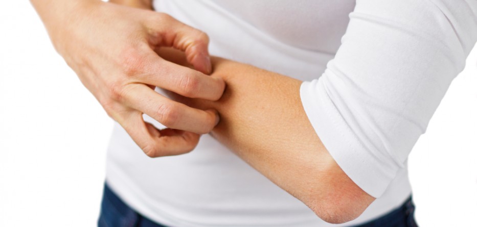 eczema atopic dermatitis