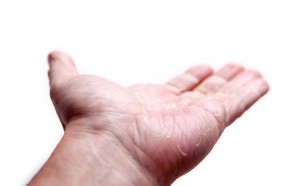 atopic dermatitis information