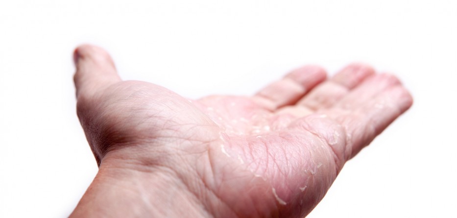 atopic dermatitis information